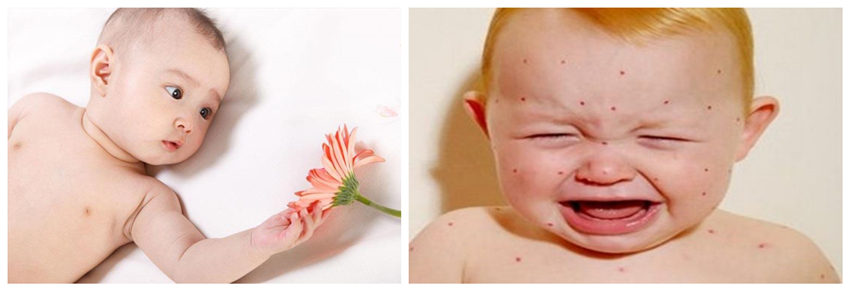 兒童濕疹反反複複，您有在家安裝家用除濕產品嗎？